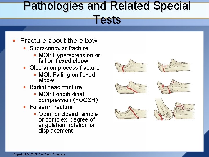 Pathologies and Related Special Tests § Fracture about the elbow § Supracondylar fracture §