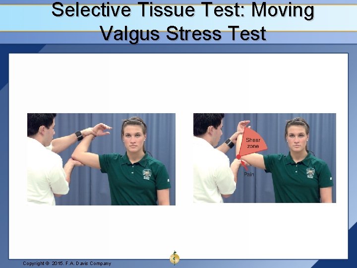 Selective Tissue Test: Moving Valgus Stress Test Copyright © 2015. F. A. Davis Company
