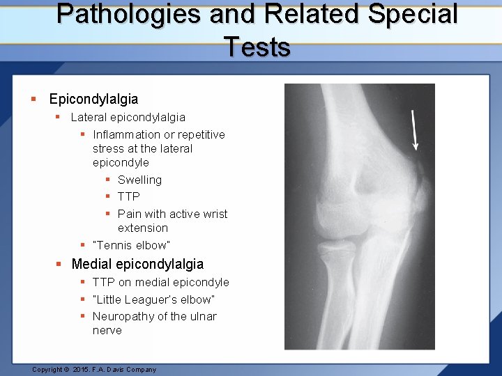 Pathologies and Related Special Tests § Epicondylalgia § Lateral epicondylalgia § Inflammation or repetitive