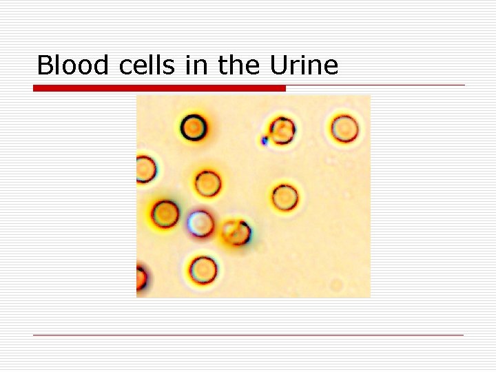 Blood cells in the Urine 