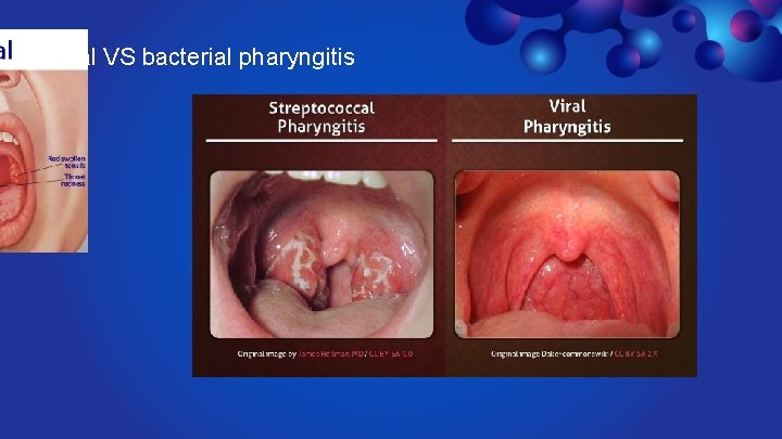 viral VS bacterial pharyngitis 