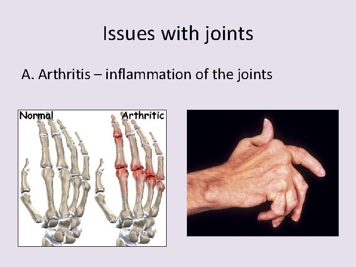 Issues with joints A. Arthritis – inflammation of the joints 