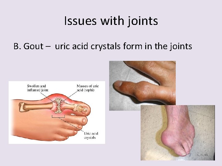 Issues with joints B. Gout – uric acid crystals form in the joints 