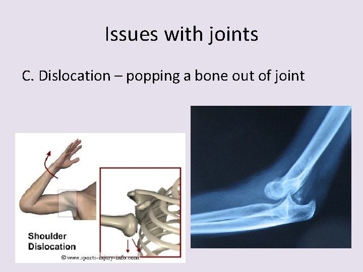 Issues with joints C. Dislocation – popping a bone out of joint 