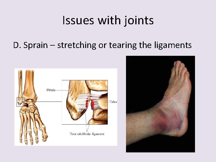Issues with joints D. Sprain – stretching or tearing the ligaments 