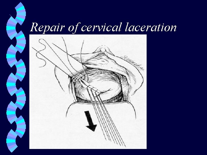 Repair of cervical laceration 