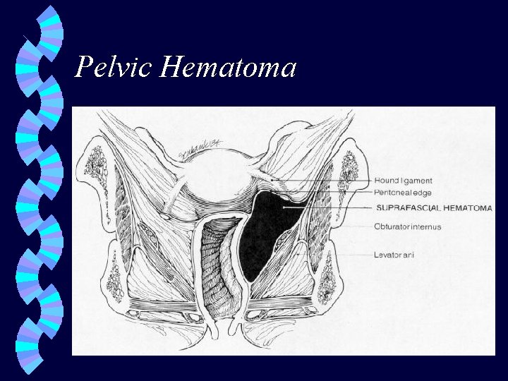 Pelvic Hematoma 