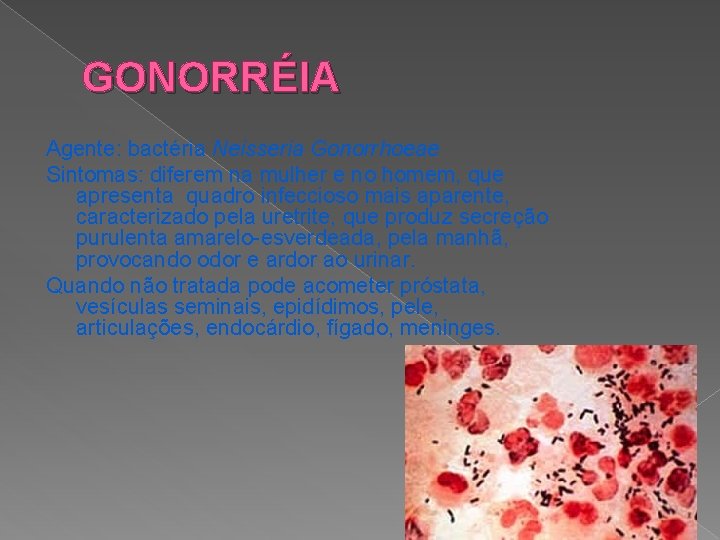 GONORRÉIA Agente: bactéria Neisseria Gonorrhoeae Sintomas: diferem na mulher e no homem, que apresenta