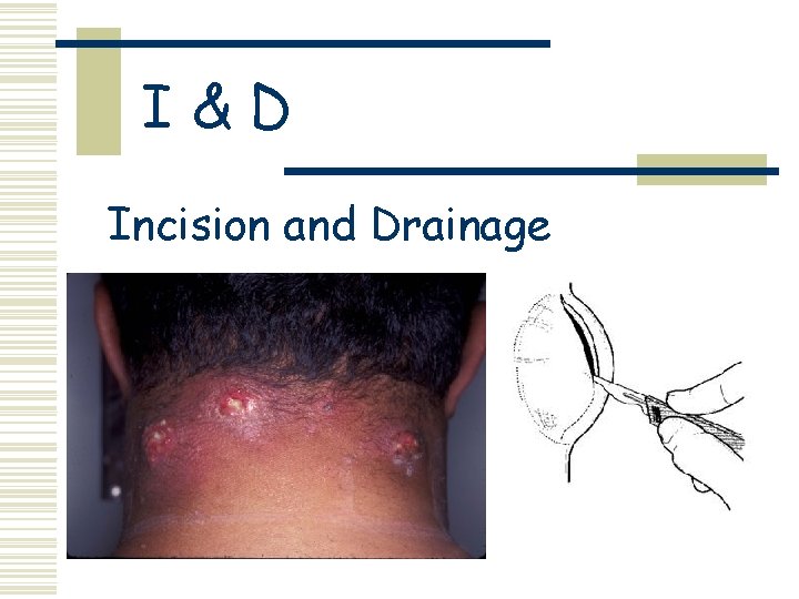 I&D Incision and Drainage 