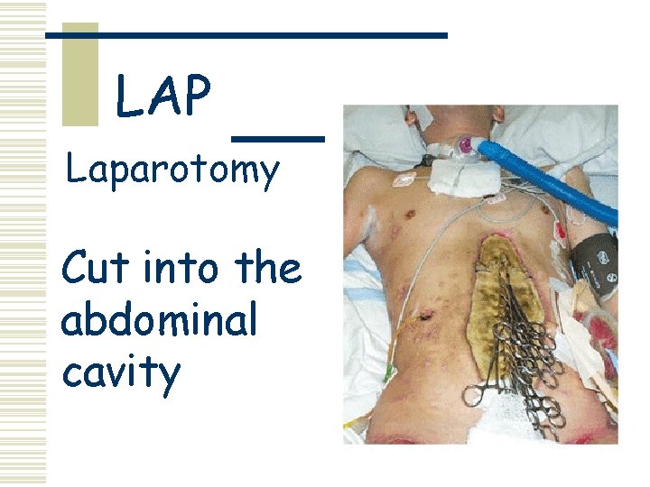 LAP Laparotomy Cut into the abdominal cavity 