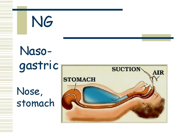 NG Nasogastric Nose, stomach 