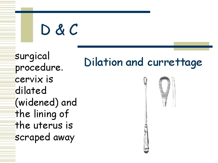 D&C surgical Dilation and currettage procedure. cervix is dilated (widened) and the lining of