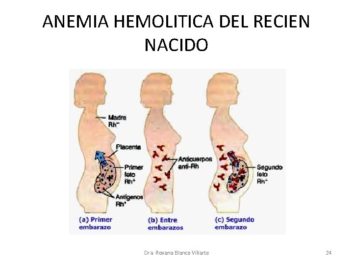 ANEMIA HEMOLITICA DEL RECIEN NACIDO Dra. Roxana Blanco Villarte 24 