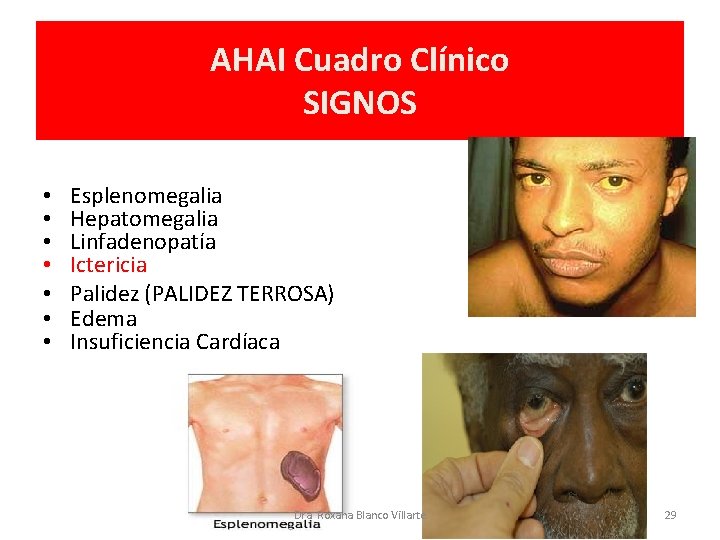 AHAI Cuadro Clínico SIGNOS • • Esplenomegalia Hepatomegalia Linfadenopatía Ictericia Palidez (PALIDEZ TERROSA) Edema