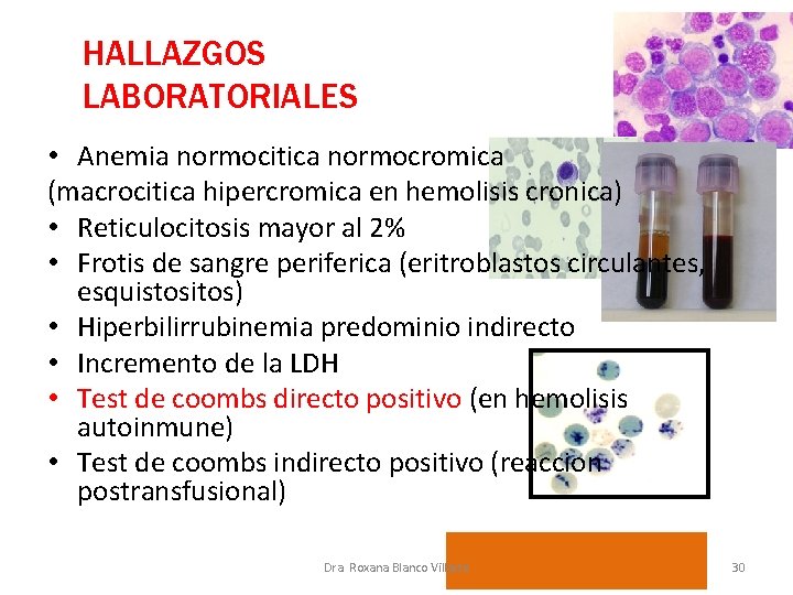 HALLAZGOS LABORATORIALES • Anemia normocitica normocromica (macrocitica hipercromica en hemolisis cronica) • Reticulocitosis mayor