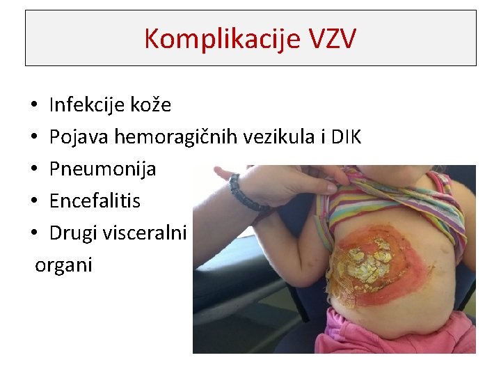 Komplikacije VZV • Infekcije kože • Pojava hemoragičnih vezikula i DIK • Pneumonija •