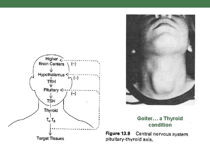 Goiter… a Thyroid condition 