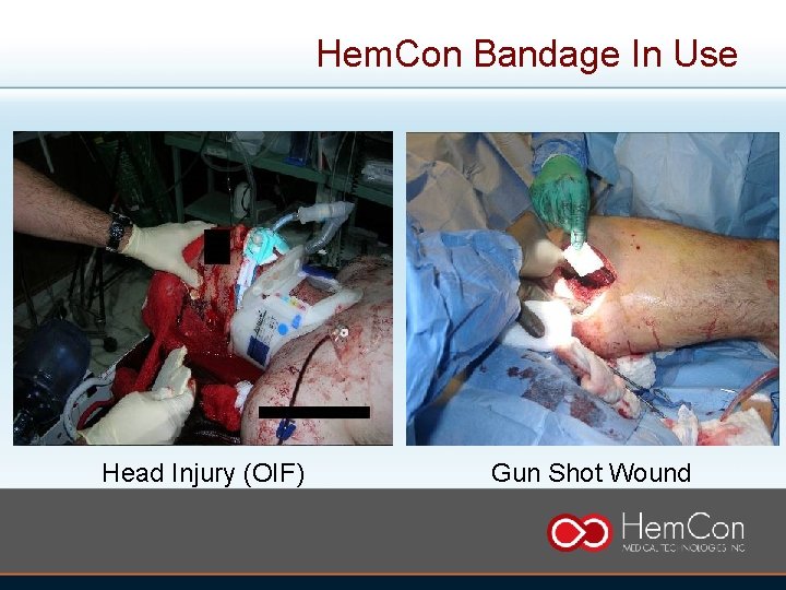 Hem. Con Bandage In Use Head Injury (OIF) Gun Shot Wound 