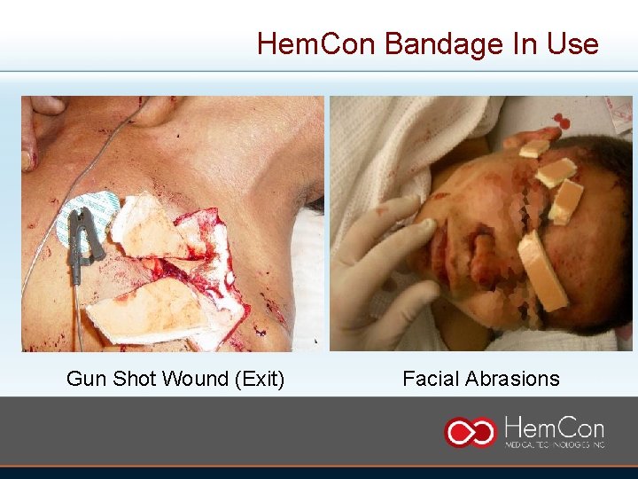 Hem. Con Bandage In Use Gun Shot Wound (Exit) Facial Abrasions 