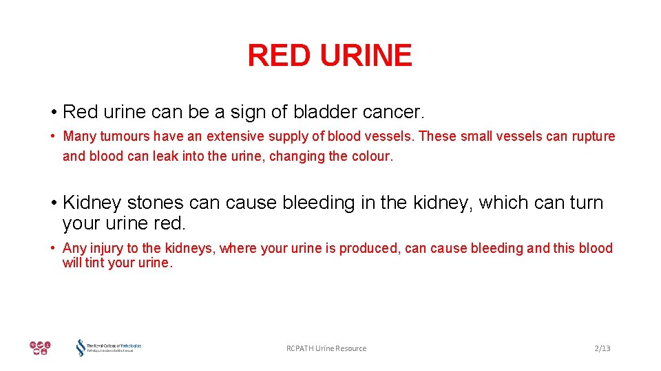 RED URINE • Red urine can be a sign of bladder cancer. • Many