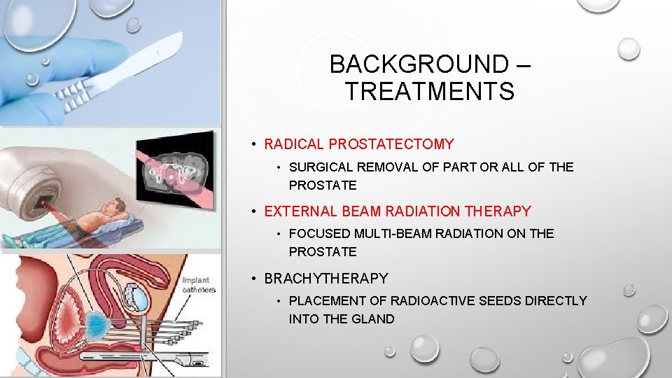 BACKGROUND – TREATMENTS • RADICAL PROSTATECTOMY • SURGICAL REMOVAL OF PART OR ALL OF
