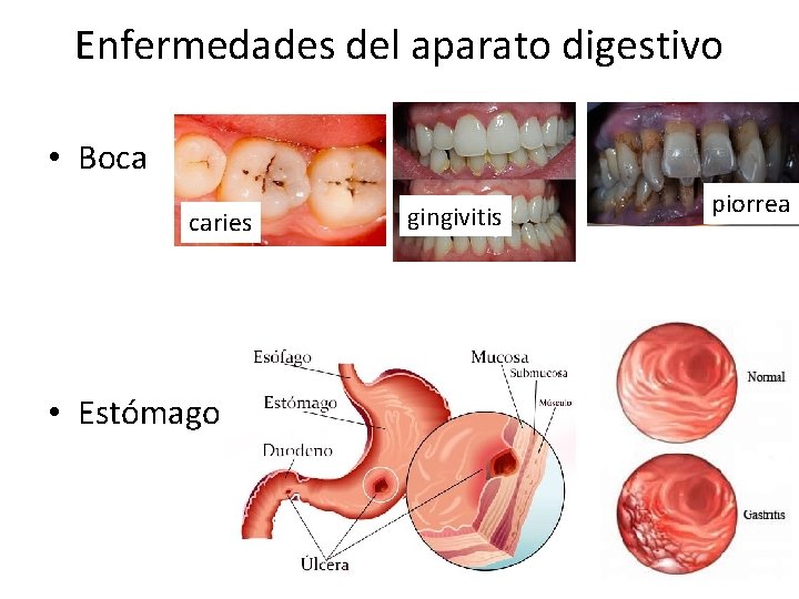 Enfermedades del aparato digestivo • Boca caries • Estómago gingivitis piorrea 