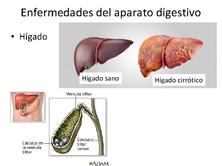 Enfermedades del aparato digestivo • Hígado sano Hígado cirrótico 