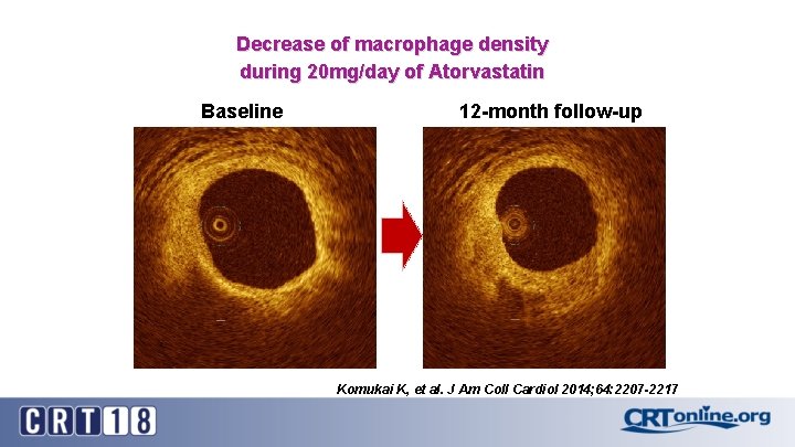 Decrease of macrophage density during 20 mg/day of Atorvastatin Baseline 12 -month follow-up Komukai