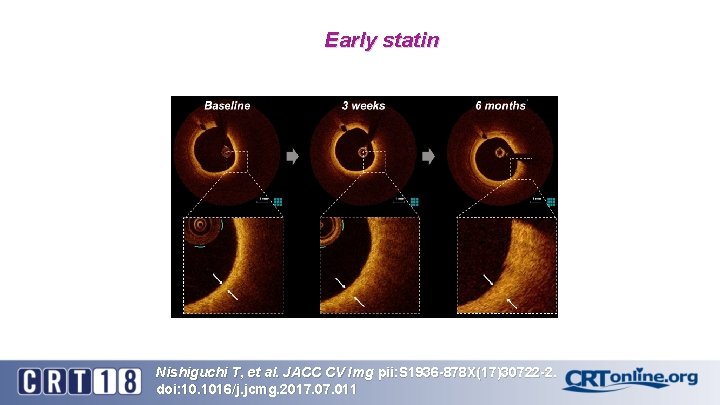 Early statin Nishiguchi T, et al. JACC CV Img pii: S 1936 -878 X(17)30722