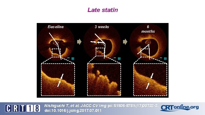 Late statin Baseline 3 weeks 6 months Nishiguchi T, et al. JACC CV Img