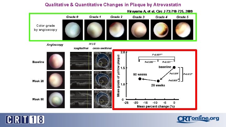 Qualitative & Quantitative Changes in Plaque by Atrovastatin Hirayama A, et al. Circ J
