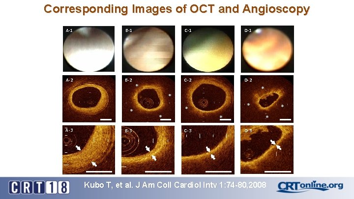 Corresponding Images of OCT and Angioscopy A-1 B-1 C-1 D-1 A-2 B-2 C-2 D-2