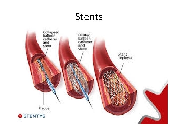 Stents 