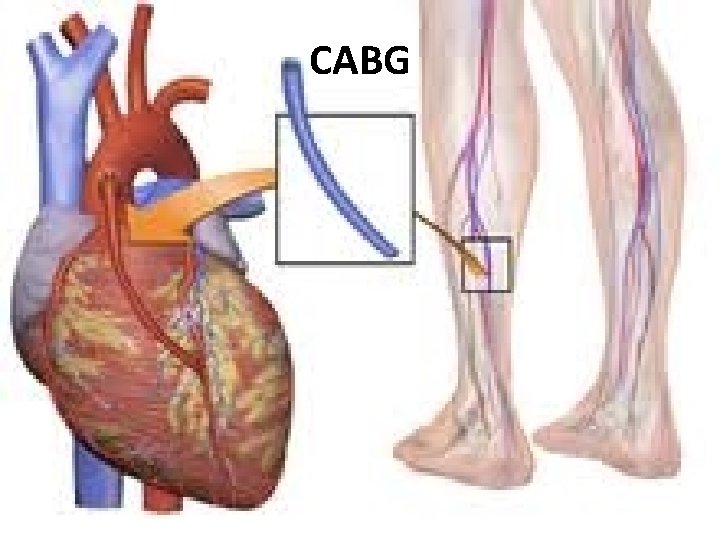 CABG 