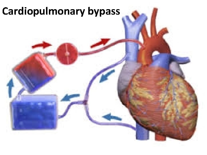 Cardiopulmonary bypass 