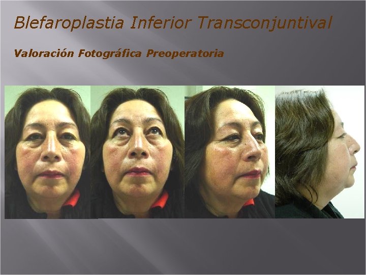 Blefaroplastia Inferior Transconjuntival Valoración Fotográfica Preoperatoria 