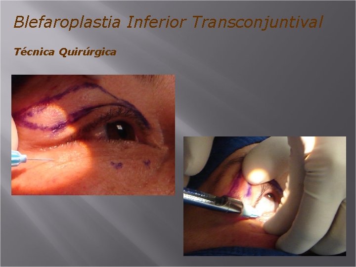 Blefaroplastia Inferior Transconjuntival Técnica Quirúrgica 