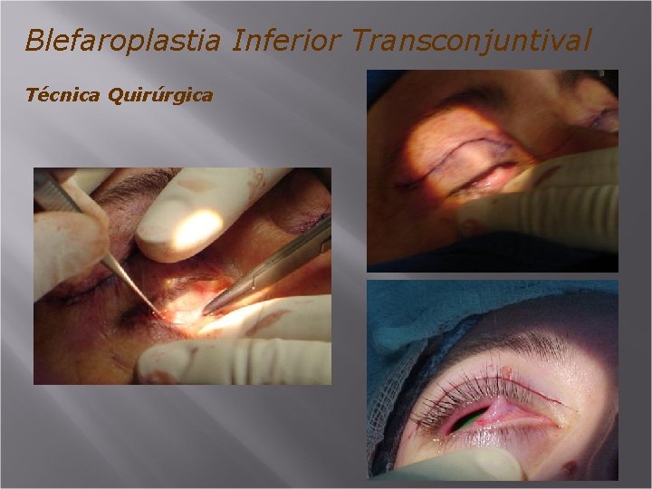 Blefaroplastia Inferior Transconjuntival Técnica Quirúrgica 