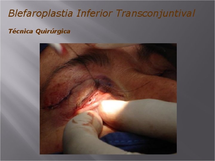 Blefaroplastia Inferior Transconjuntival Técnica Quirúrgica 