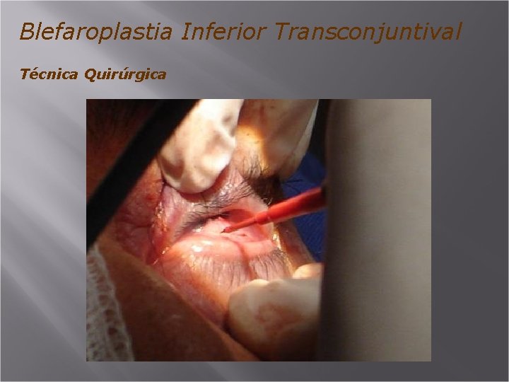 Blefaroplastia Inferior Transconjuntival Técnica Quirúrgica 
