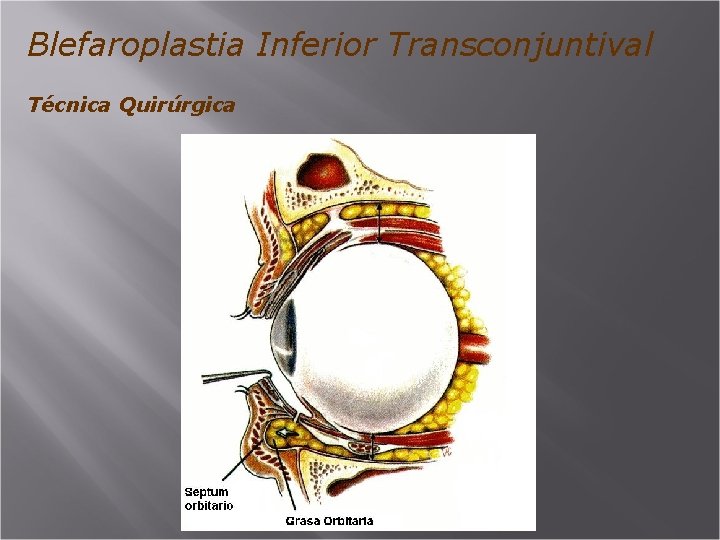 Blefaroplastia Inferior Transconjuntival Técnica Quirúrgica 