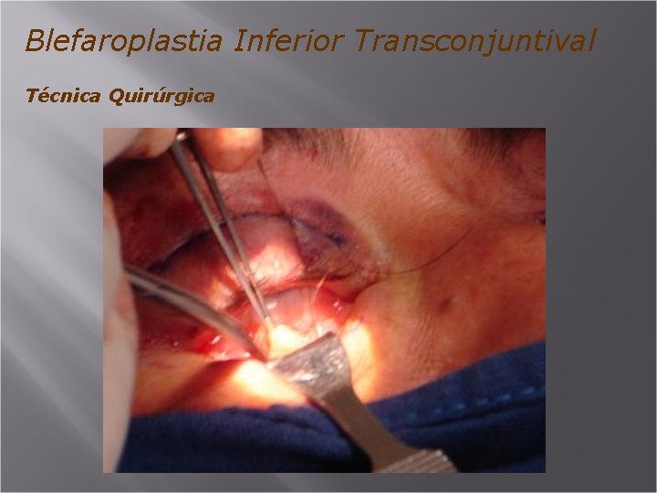 Blefaroplastia Inferior Transconjuntival Técnica Quirúrgica 