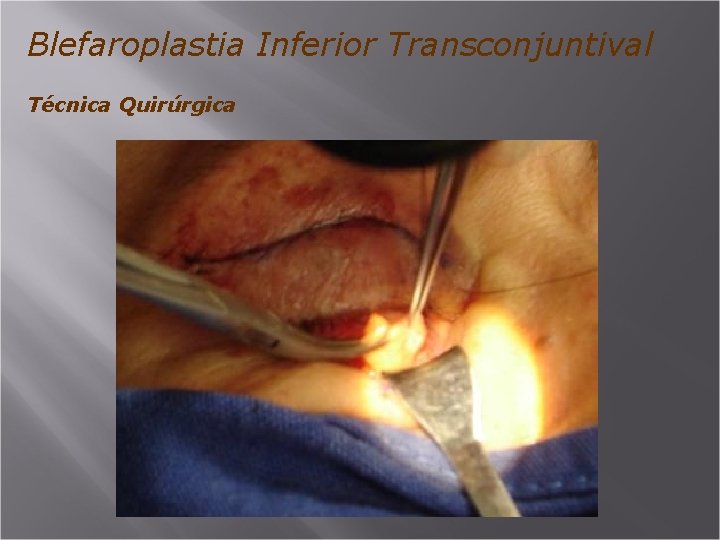 Blefaroplastia Inferior Transconjuntival Técnica Quirúrgica 