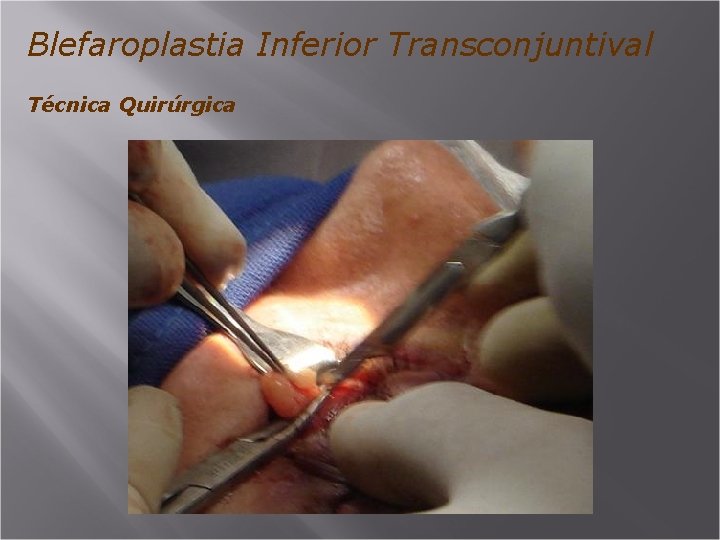 Blefaroplastia Inferior Transconjuntival Técnica Quirúrgica 