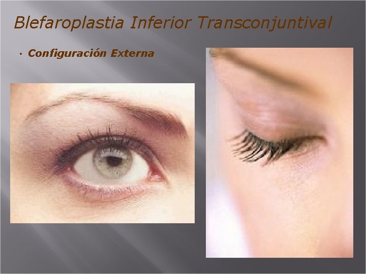 Blefaroplastia Inferior Transconjuntival • Configuración Externa 