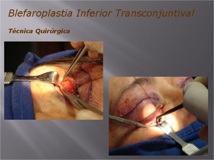 Blefaroplastia Inferior Transconjuntival Técnica Quirúrgica 