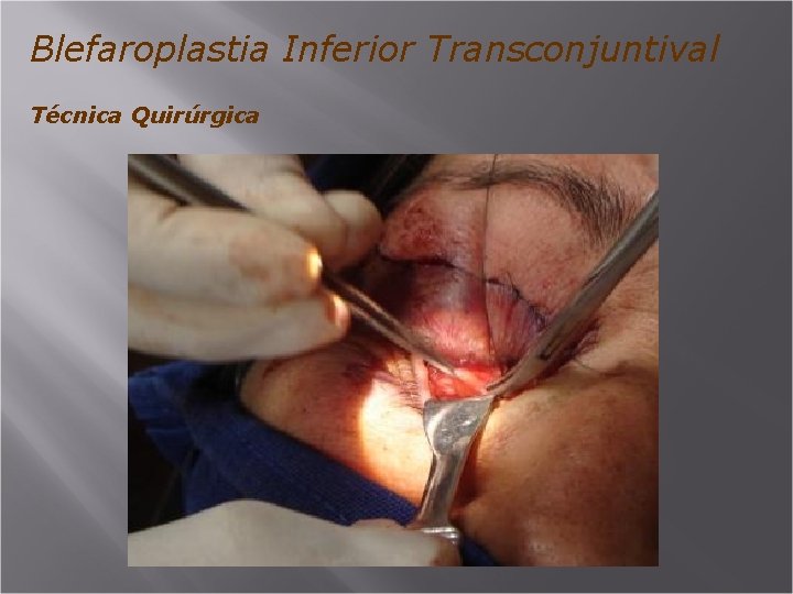 Blefaroplastia Inferior Transconjuntival Técnica Quirúrgica 