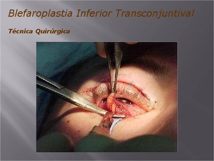 Blefaroplastia Inferior Transconjuntival Técnica Quirúrgica 