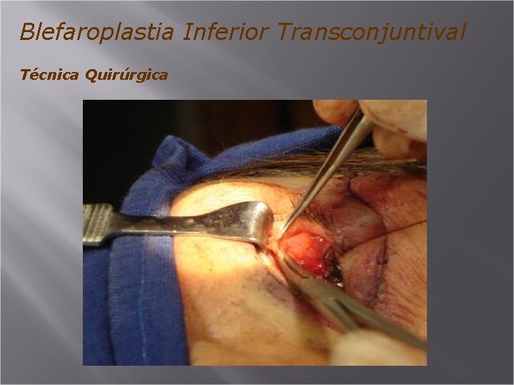 Blefaroplastia Inferior Transconjuntival Técnica Quirúrgica 