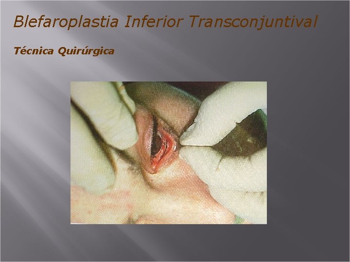 Blefaroplastia Inferior Transconjuntival Técnica Quirúrgica 